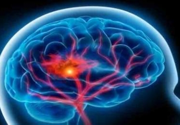 Intracranial Hemorrhages