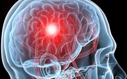 Cerebrovascular Diseases