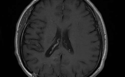 Glial Beyin Tümörü Post-Op MR